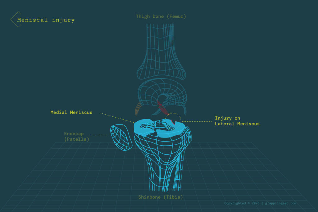 Most common injuries in grappling arts and contact sports public articles