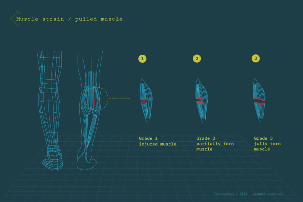 Most common injuries in grappling arts and contact sports public articles